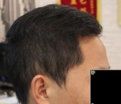 -大麦微针植发丨全国连锁
