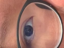 体验前-KS科逆美肤祛痘