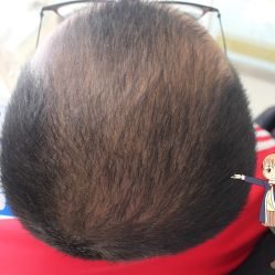 -大麦微针植发丨全国连锁