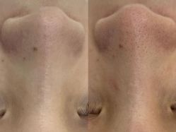 -凡碧诗毛孔清洁收细