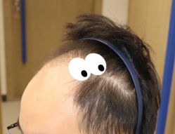 -大麦微针植发全国连锁