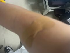 -杭州仁易堂中医康复医院疤痕修复
