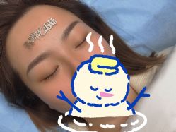 体验后-郡艺医疗美容·微整·眼鼻吸脂