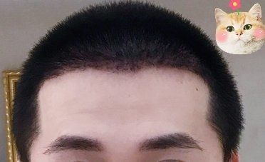 -大麦微针植发丨全国连锁