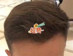 -大麦微针植发全国连锁