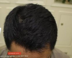 -大麦微针植发丨全国连锁