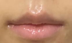 体验后-More摩尔医美の注射线雕光电中心