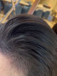 -碧莲盛·不剃发植发