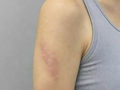 -杭州仁易堂中医康复医院疤痕修复