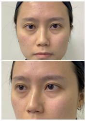 -广州健丽·去眼袋医疗美容机构
