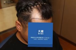 -大麦微针植发全国连锁