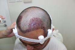 点击看大图 -大麦微针植发丨全国连锁