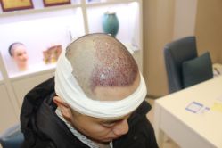 -大麦微针植发丨全国连锁