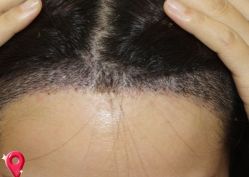 -大麦微针植发丨全国连锁