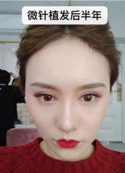 点击看大图 -大麦微针植发全国连锁