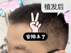 -大麦微针植发全国连锁