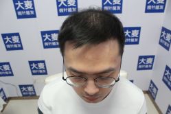 -大麦微针植发丨全国连锁
