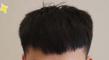 -大麦微针植发丨全国连锁