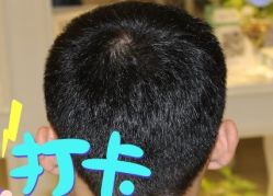-大麦微针植发全国连锁