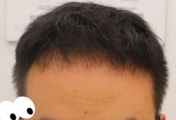 -大麦微针植发全国连锁