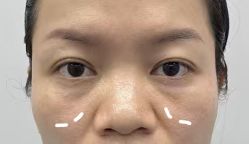 -天津健丽·去眼袋医疗美容机构