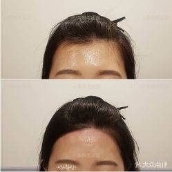 -小梨·OndaPro·专业脱毛连锁机构