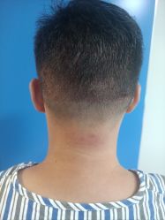 -碧莲盛·不剃发植发