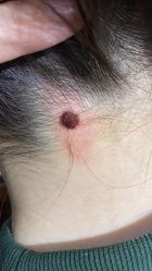 -痣斑堂·取大痣