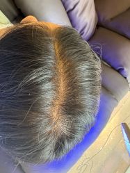 -碧莲盛·不剃发植发