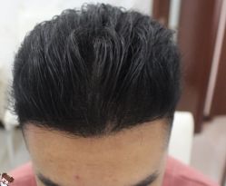 -大麦微针植发丨全国连锁