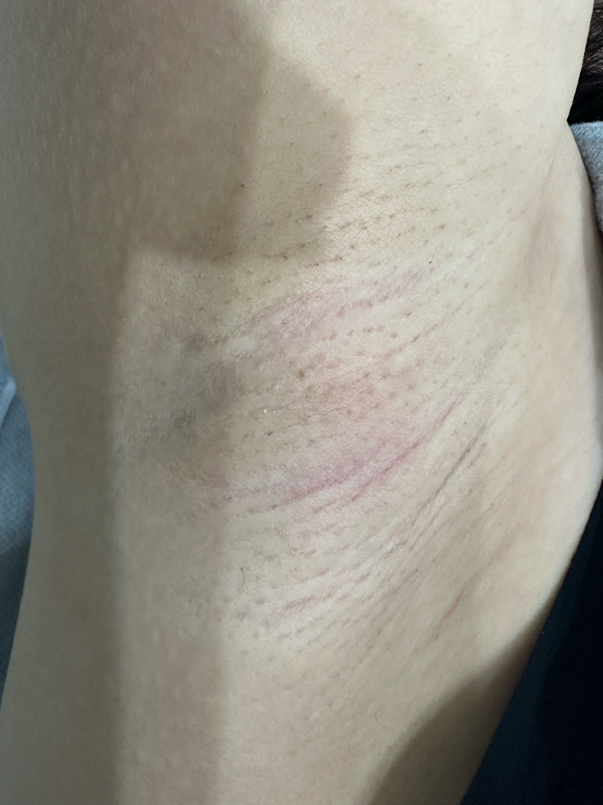 冰点脱毛7次为什么还长