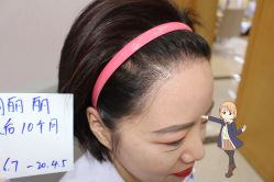 -大麦微针植发丨全国连锁