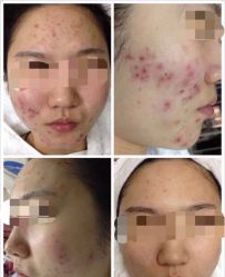 -美肤盾祛痘·问题肌头疗管理中心