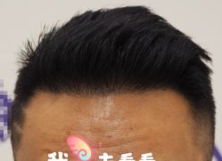 -大麦微针植发全国连锁