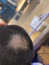 -碧莲盛·不剃发植发