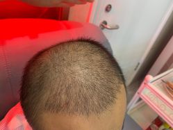 -碧莲盛·不剃发植发