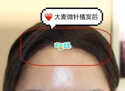 -大麦微针植发全国连锁