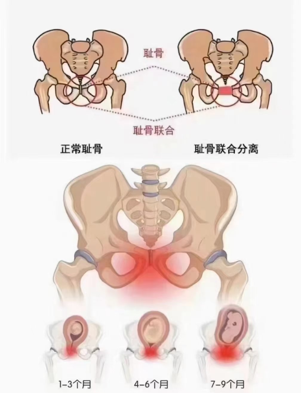 耻骨分离的症状图片图片