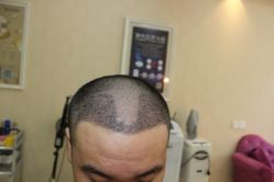 -大麦微针植发丨全国连锁