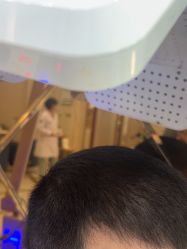 -碧莲盛·不剃发植发