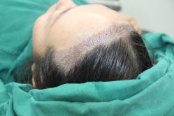 -大麦微针植发丨全国连锁