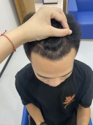 -大麦微针植发全国连锁