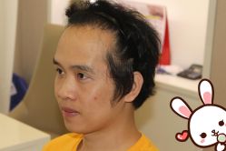 -大麦微针植发丨全国连锁