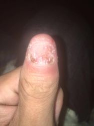 -德哥灰指甲脚气甲沟炎跖疣护理