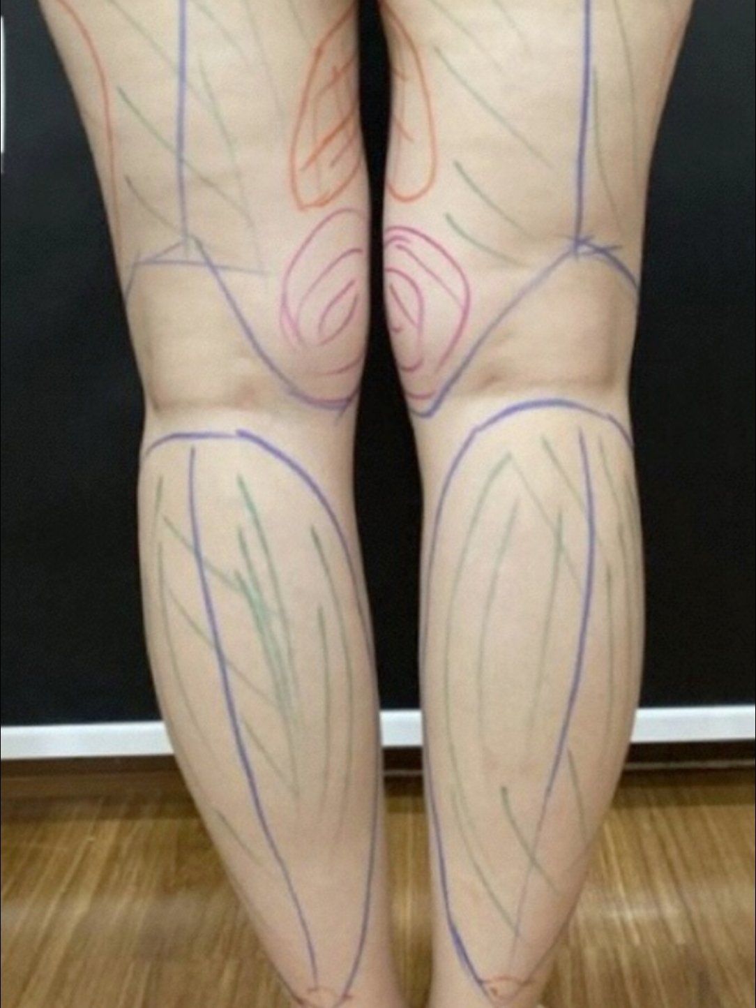 【半岛黄金微雕大腿吸脂】体验30天后效果分享