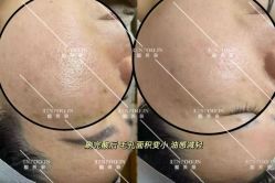 -靓芙泉专研痘痘肌