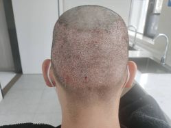 -大麦微针植发丨全国连锁