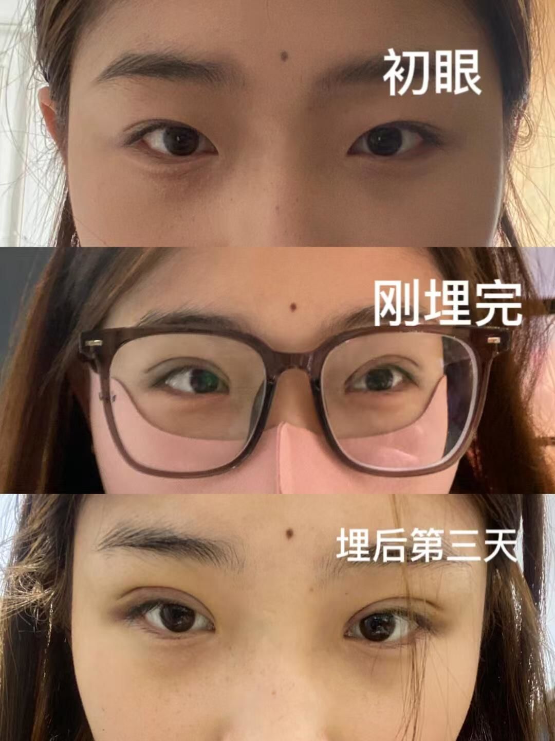 埋线双眼皮十三天!
