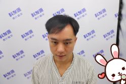 点击看大图 -大麦微针植发丨全国连锁