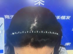 -雍禾植发全国连锁